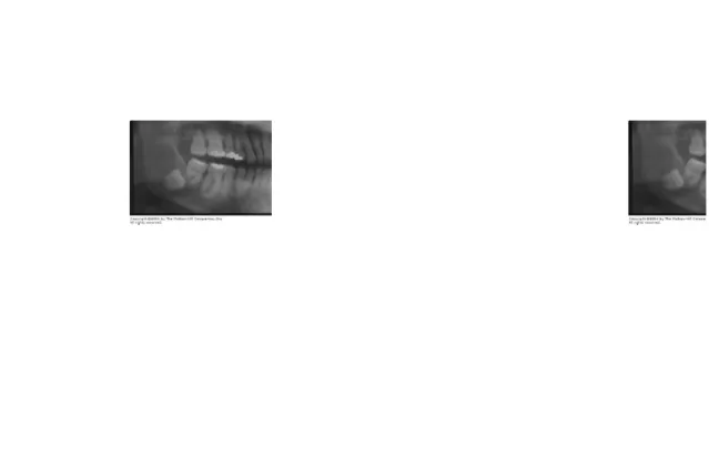 Gambar  8 . Gambaran X-ray menunjukkan kista dentigerous tampak radiolusen mengelilingi mahkota pada gigi molar tiga mandibular 2