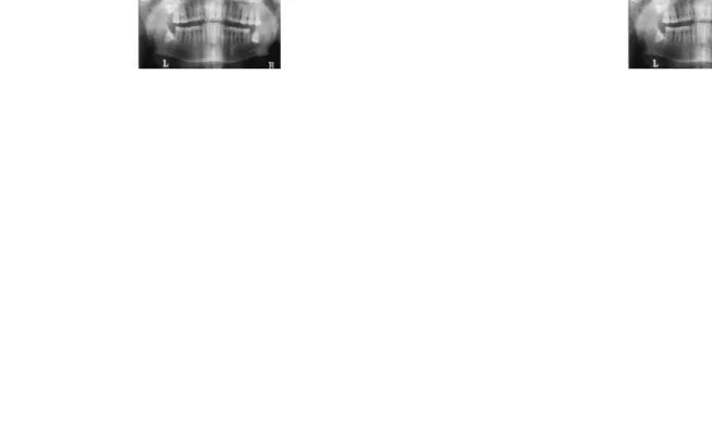Gambar 9. Gambaran X-ray menunjukkan kista dentigerous tampak radiolusen mengelilingi mahkota pada gigi molar tiga mandibular 12