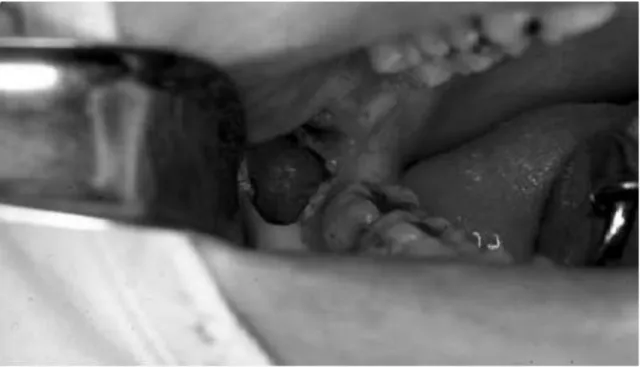 Gambar 6.  Kista Dentigerous 2
