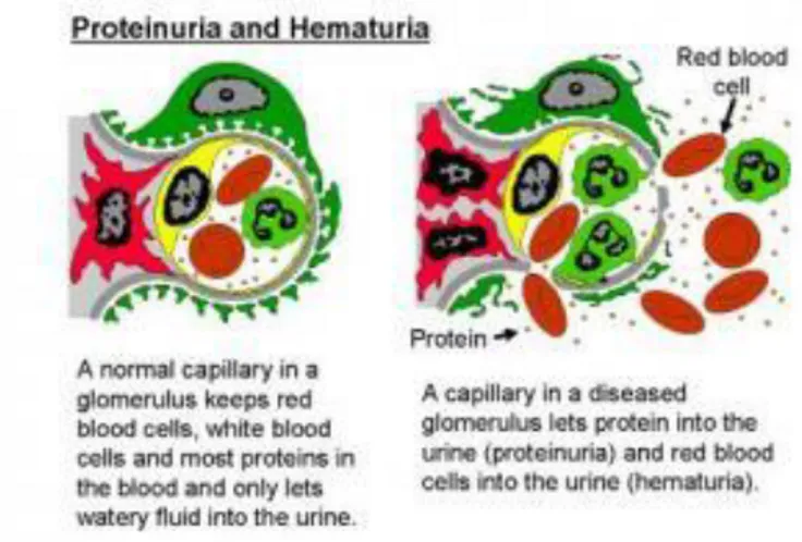 Gambar 3.1 proses terjadinya proteinuria dan hematuria 