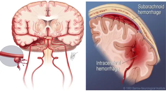 Gambar 4: Perdarahan Subarachnoid