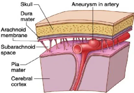 Gambar 5: Aneurisma pada arteri cerebri