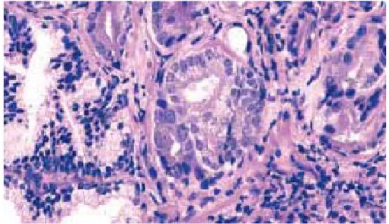 Gambar 2.4. Adenokarsinoma prostat dengan sitoplasma yang amphophilic dan inti membesar  serta nukleoli yang menonjol (Dikutip dari: Eble JN, Sauter G, Epstein JI, Sesterhenn IA