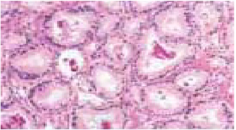 Gambar 2.5. Kristaloid intraluminal pada adenokarsinoma prostat yang low grade (Dikutip dari: 