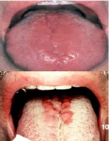 Gambar 12. Lesi pada glositis 7,9