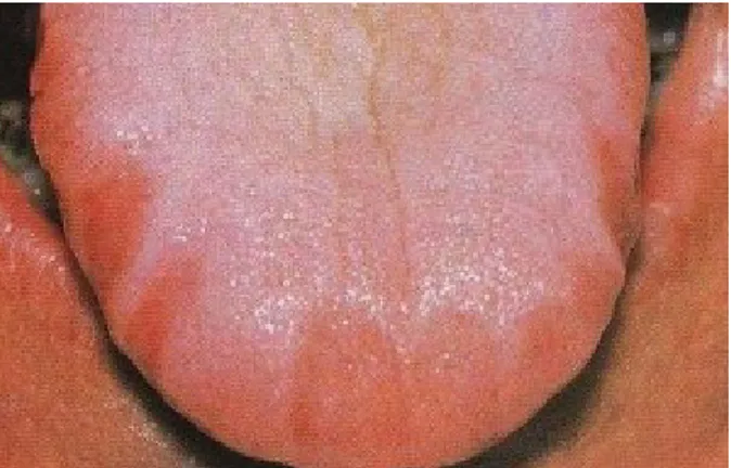 Gambar 13. Scalloped tongue 2 14. Kista Blandin-Nuhn (Kista retensi Lingual mukosa)
