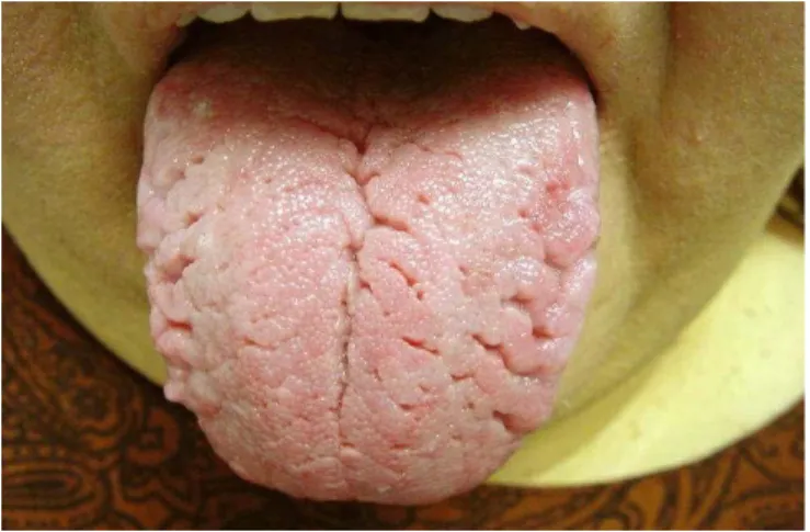 Gambar 15. Fissured tongue 2 16. Bald tongue