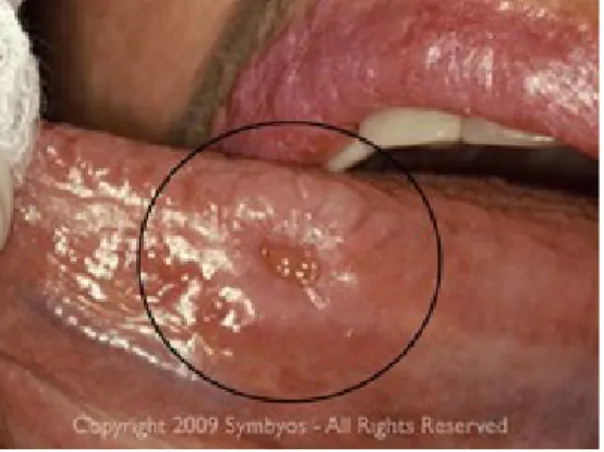 Gambar 17. Ca sel squamosa pada lateral lidah 14