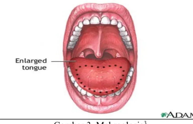 Gambar 3. Makroglosia 3 2. Mikroglosia