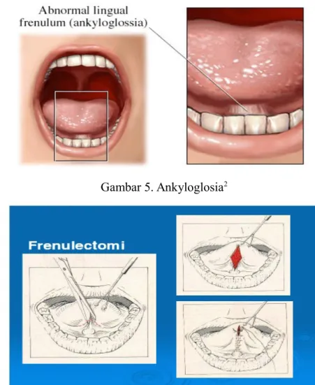 Gambar 6. Teknik frenulectomi 2 4. Sumbing lidah (cleft tongue) 11