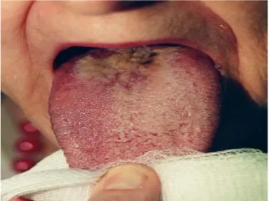 Gambar 10. Hairy tongue  9