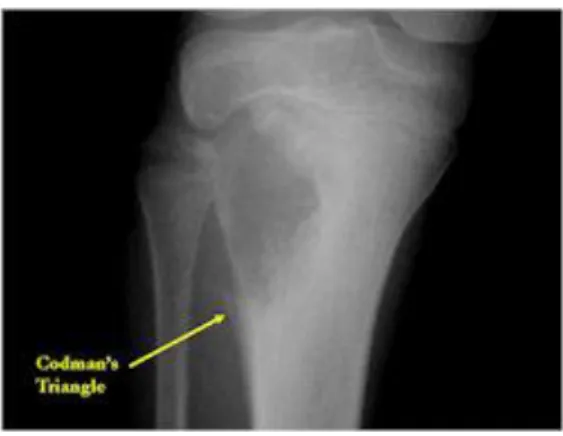 Gambar 2.2: Gambaran telangiektasis osteosarkoma os. Tibia proximal pada X-ray 