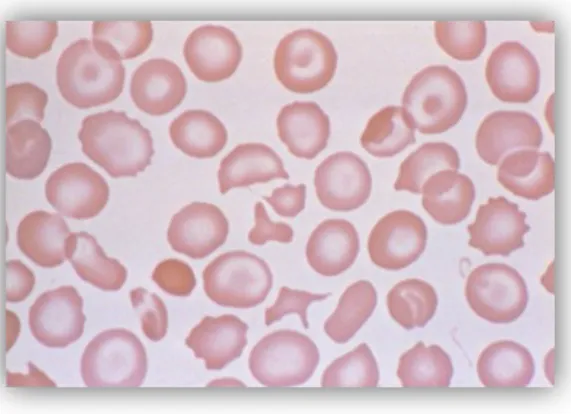Gambar 2. Sapuan apus darah tepi Penyakit Hb H pada neonatus