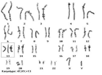 Gambar 3. Karyotipe 47, XY, +13
