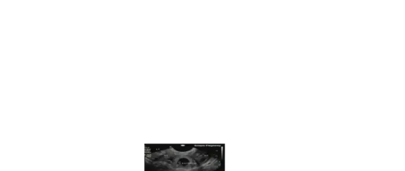 Gambar 5. USG kehamilan ektopik