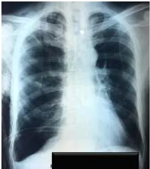 Gambar 2. Rontgen thoraksfollow up  Berdasarkan hasil tersebut pasien 