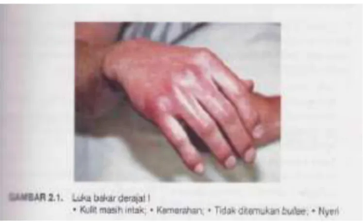 Gambar 2. Luka bakar derajat I
