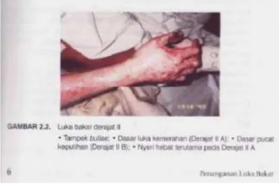 Gambar 3. Luka bakar derajat II