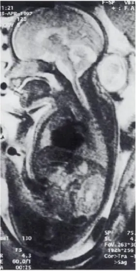 Gambar 2.10 Gambaran MRI ensefalokel oksipital. 3