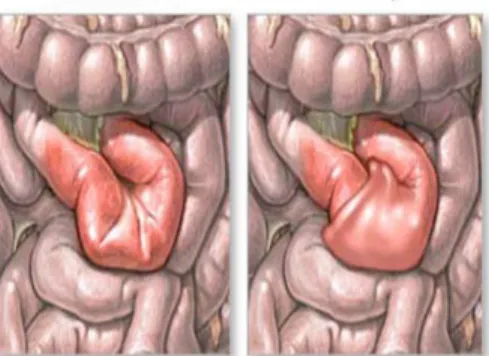 Gambar 1. Perbandingan usus normal dan usus yang mengalami intusussepsi Intususepsi   menggambarkan   masuknya   segmen   proksimal   usus (intususeptum)   ke   dalam   lumen   usus   distal   (intususepiens)