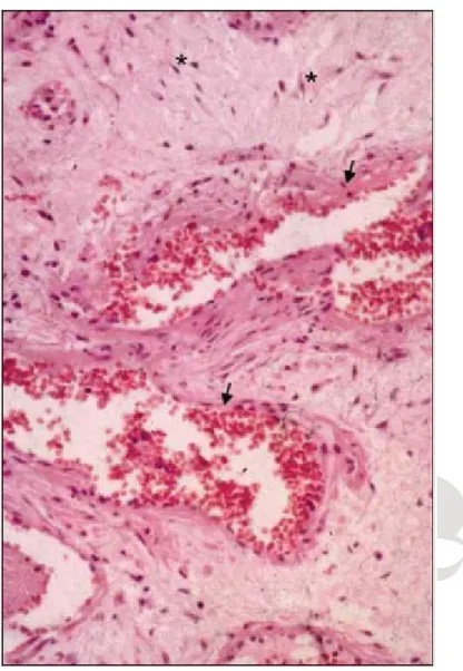 Gambar 1. Reseksi pasca operasi dari JNA. Tampak sebuah massa yang besar, tidak  bertangkai (sessile), berwarna kemerahan yang sebelumnya berada dalam nasofaring