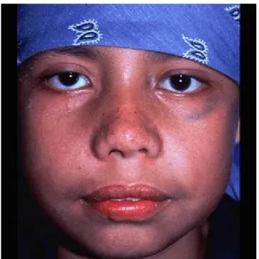 Gambar 3. Foto seorang anak dengan JNA.  Perhatikan penonjolan mata dan bagian  tengah wajahnya karena penekanan dari tumor.