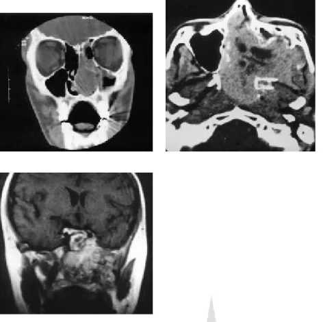 Gambar 4a (atas kiri).  CT scan coronal dari lesi yang mengisi rongga hidung kiri dan  sinus ethmoidalis