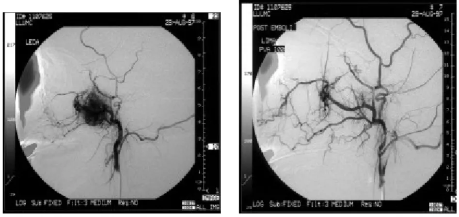 Gambar 6a (kiri). Gambaran angiografi JNA sebelum embolisasi Gambar 6b (kanan). Gambaran angiografi setelah embolisasi