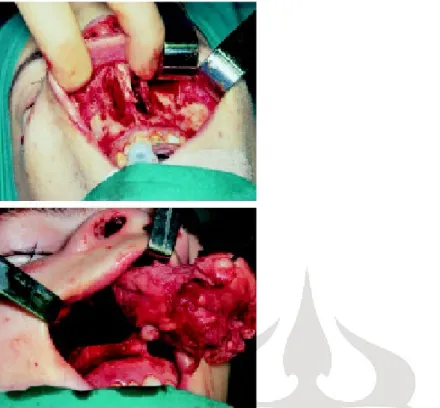 Gambar   7a   dan   7b.   Operasi   pembedahan   JNA   dengan   pendekatan  midfacial   degloving