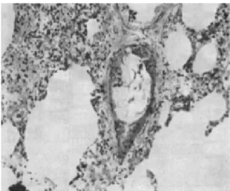 Gambar 3. Arteri kecil di dalam paru menunjuk- menunjuk-kan gambaran bagian tengah pembuluh darah  yang diblokir oleh embolisme sel skuamosa  (skua-mosa epitelial dan vernix  caseosa)