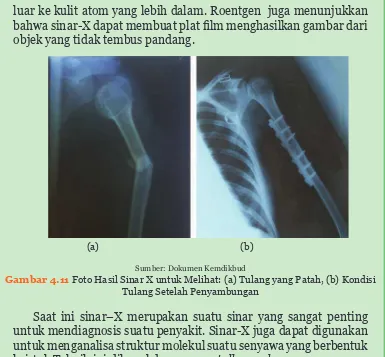 Gambar 4.11 Foto Hasil Sinar X untuk Melihat: (a) Tulang yang Patah, (b) Kondisi 