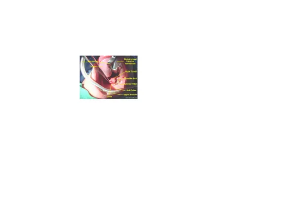 Gambar 3.3: tonsilektomi. Diunduh dari www.ghorayeb.com/TonsillectomyPic.html pada tanggal 30 juli 2009 pukul 20.12