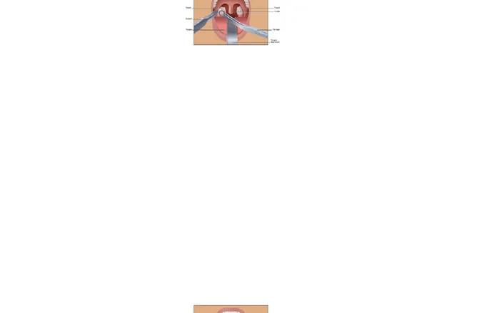 Gambar 3.6 cara tonsilektomi