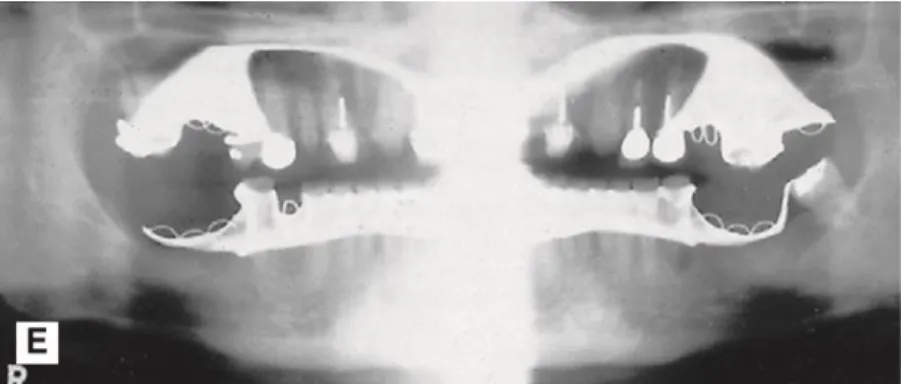 Gambar 2.9. Kesalahan tidak melepaskan gigi tiruan sebagian  logam atas dan bawah. 10 