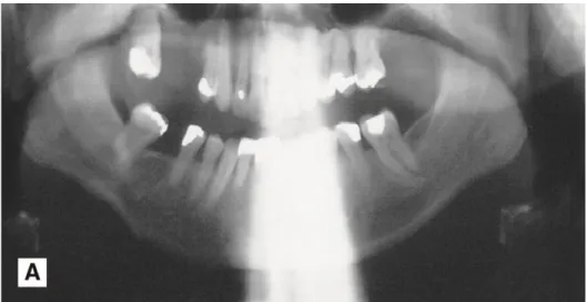 Gambar 2.13. Gigi insisivus tengah berada di depan alur gigitan,  menyebabkan mereka tampak kurus dan tidak jelas