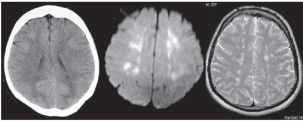 Gambar CT menunjukkan perubahan hipodens minimal di wilayah periventricular