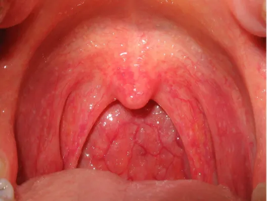 Gambar 2.4. Viral Pharyngitis