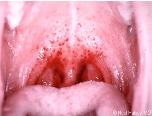 Gambar 2.4. Streptococcal Pharyngitis
