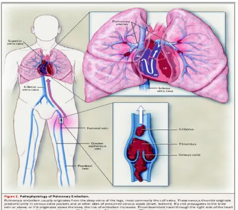 Gambar 1. Patofisiologi emboli paru 