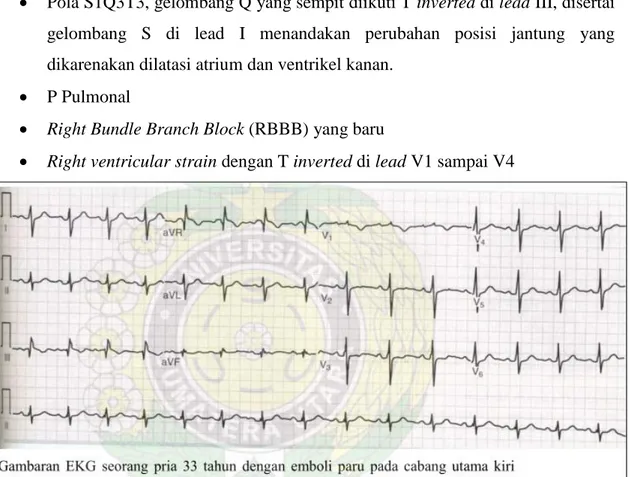 Gambar 4. EKG Pasien Emboli Paru 