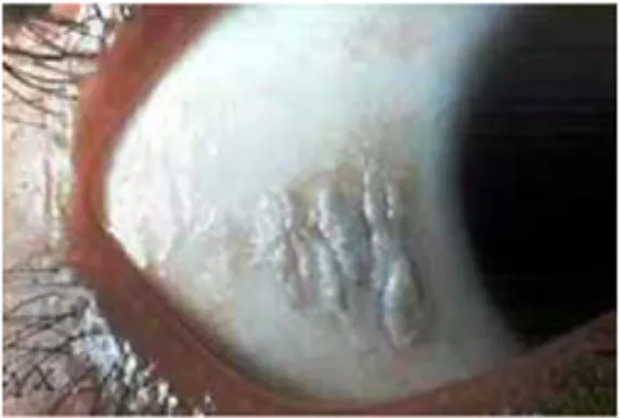 Gambar 5. Bercak Bitot pada mata  o  Konjungtiva atau kornea yang kering, bercak Bitot  o  Ulkus kornea 