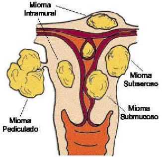 Gambar 1. Jenis-jenis mioma uteri.  (3)
