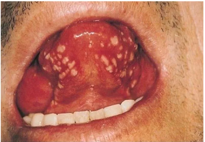 Gambar 3.3   Stomatitis aphtosa rekuren(SAR) herpetiform pada dasar lidah   (Laskaris, 2006)