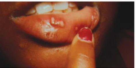 Gambar   4-2  wanita   12   tahun   dengan   herpes   gingivostomatis   primer   terdapat vasikel dan ulser dengan tepi yang terinflamasi (Greenberg, 2003)
