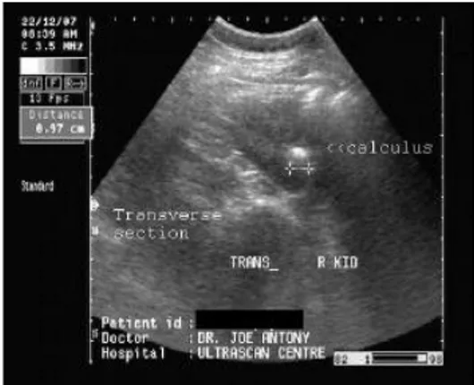Gambar 1. Gambaran calculi pada ultrasonografi