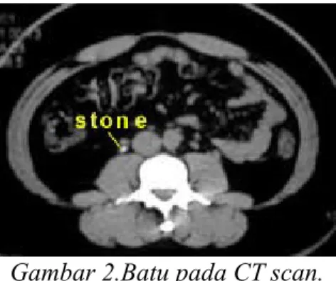Gambar 2.Batu pada CT scan.