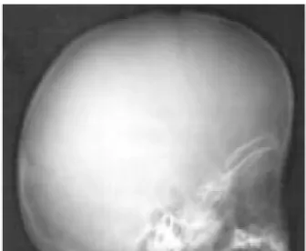 Gambar 2.2 Foto kepala pada anak dengan hidrosefalus Dengan prosedur ini dapat diketahui: