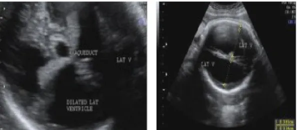Gambar 2.3 Foto USG kepala fetus pada trimester ketiga. Tampak dilatasi bilateral dari kedua ventrikel lateralis (gambar a) dan penipisan jaringan otak (gambar b).