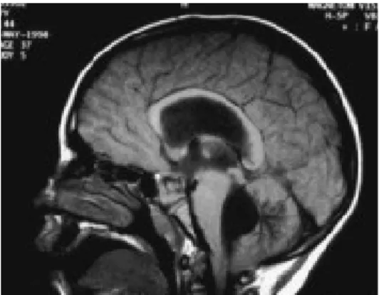 Gambar 2.5 MRI potongan sagital pada gidrosefalus nonkomunikans akibat obstruksi pada foramen Luscka dan magendie