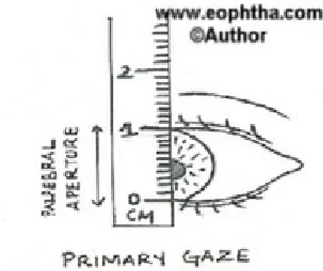 Gambar 3. Pemeriksaan Palpebra Fissure Height